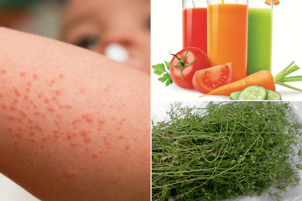 Nguyên nhân và triệu chứng của bệnh sốt phát ban là gì?