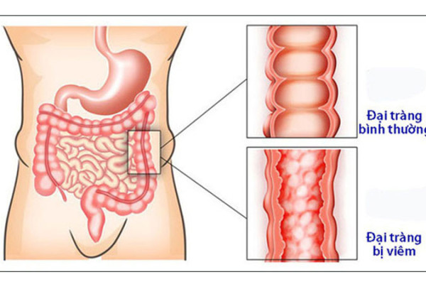 Nhận biết bệnh viêm đại tràng qua dấu hiệu nào? Bệnh viêm đại tràng có nguy hiểm không?