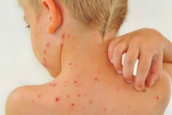 Những biến chứng không thể xem thường khi mắc bệnh Rubella