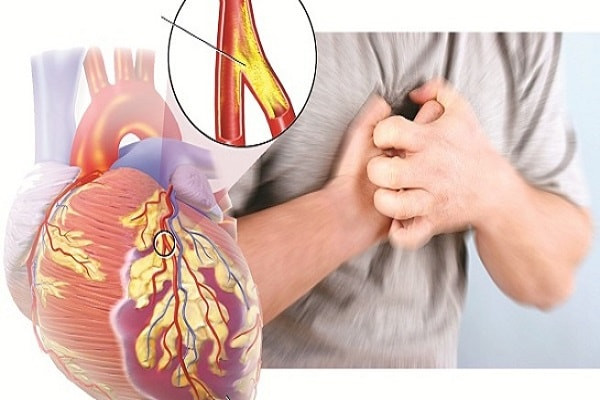 Đặt stent mạch vành có nguy hiểm không?