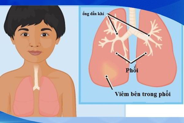 Những dấu hiệu nhận biết bệnh viêm phổi ở trẻ nhỏ
