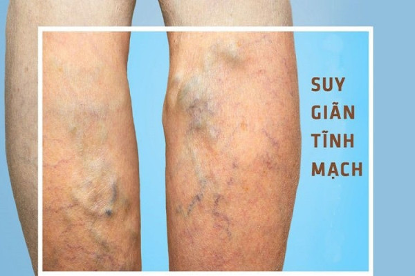 Những điều bạn cần biết về bệnh suy giãn tĩnh mạch chi dưới