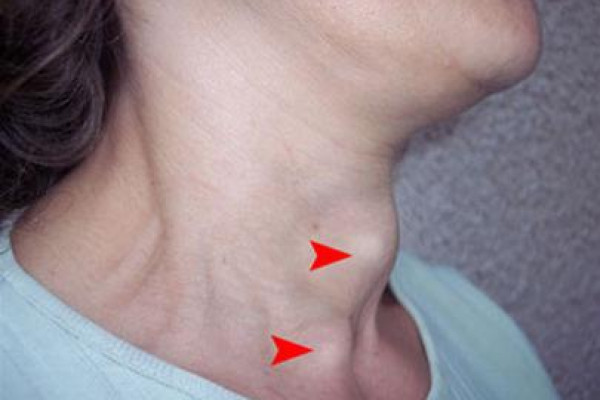 Những điều cần biết về bệnh Basedow