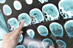 nhung-dieu-can-biet-ve-chung-benh-batten-nguy-hiem