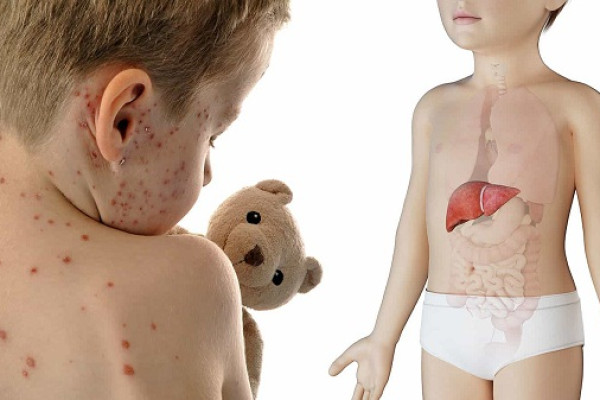 Những điều cần biết về hội chứng Reye ở trẻ em