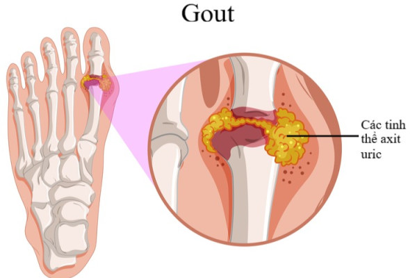 Những loại thuốc gout mạn tính tốt nhất hiện nay
