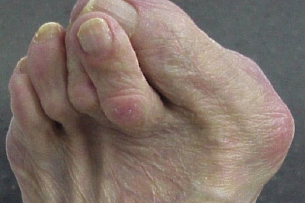 Những phương pháp nào dùng để điều trị ngón chân hình búa?