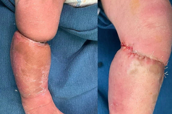 Phẫu thuật tạo hình cho bé trai sơ sinh mắc hội chứng vòng thắt bẩm sinh