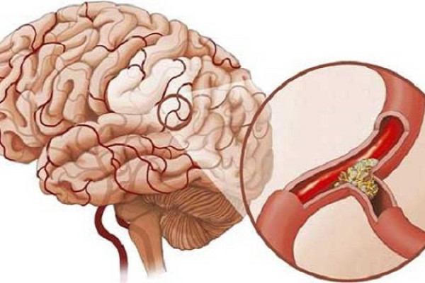 Phương pháp điều trị cho bệnh nhân nhồi máu não