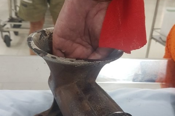 Rùng mình máy xay thịt nuốt gần hết bàn tay