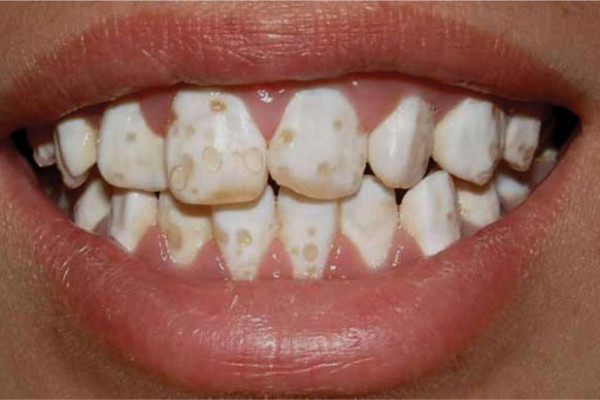 Thiểu sản men răng là gì? Có nguy hiểm không?