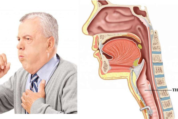 Thông tin cần biết về bệnh hẹp thanh quản và cách điều trị