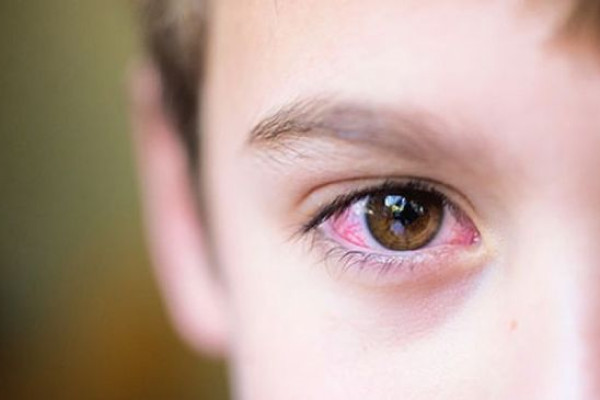 Tìm hiểu bệnh khô mắt ở trẻ em và cách điều trị