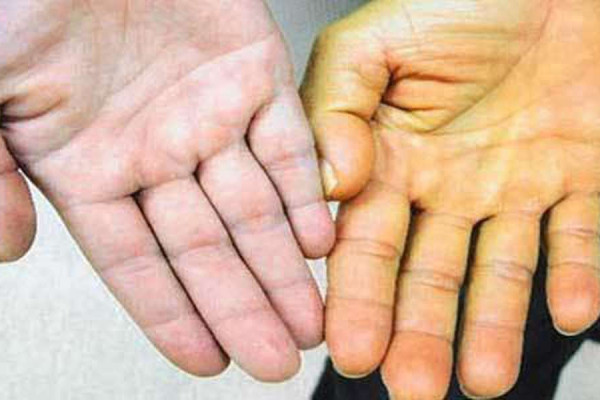 Tìm hiểu chung hội chứng Gilbert