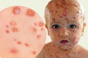 trieu-chung-va-cach-dieu-tri-hieu-qua-benh-thuy-dau