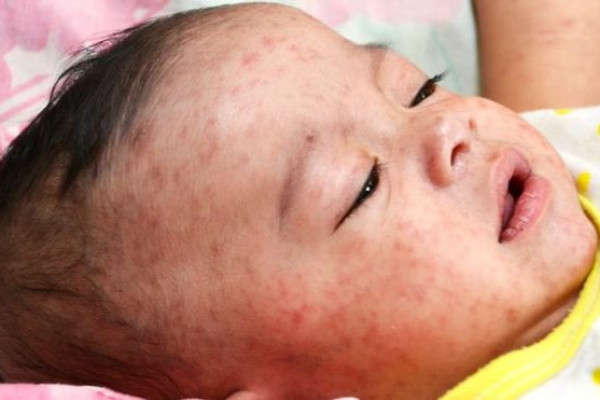 Viêm màng não do não mô cầu nguy hiểm như thế nào?