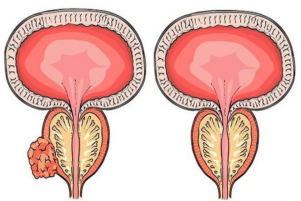 Viêm tiền liệt tuyến nguy hiểm như thế nào?