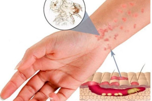 benh-ghe-nuoc-la-gi-cac-phuong-phap-dieu-tri-dut-diem-benh-ghe-nuoc