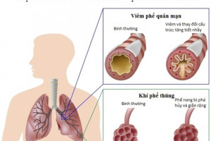 benh-phoi-tac-nghen-man-tinh-co-nguy-hiem-khong