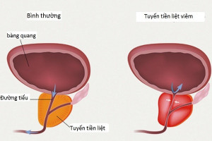 benh-u-xo-tien-liet-tuyen-dieu-tri-bang-loai-thuoc-gi