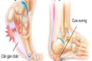 benh-viem-can-gan-chan-la-gi-dau-hieu-nhan-biet-benh-cach-dieu-tri-ra-sao