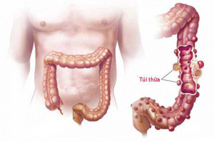 benh-viem-tui-thua-co-nguy-hiem-khong-co-cach-dieu-tri-nao-huu-hieu