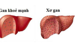 benh-xo-gan-co-may-giai-doan-cac-trieu-chung-nhan-biet-benh-ra-sao