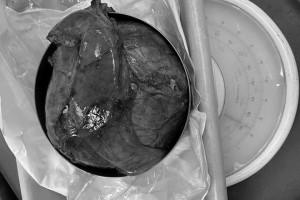 ca-mo-10-tieng-boc-tach-khoi-u-dau-tuy-khung-nhat-the-gioi