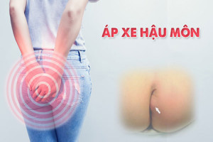 cac-bien-chung-cua-ap-xe-hau-mon-co-dau-hieu-nao-de-nhan-biet-som-ap-xe-hau-mon