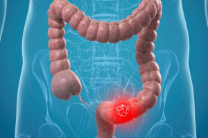 cac-bien-phap-duoc-su-dung-trong-dieu-tri-benh-viem-ruot