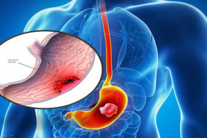 cac-dau-hieu-canh-giac-benh-viem-loet-da-day