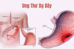 cac-dau-hieu-nhan-biet-som-benh-ung-thu-da-day