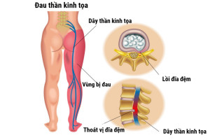 cac-phuong-phap-dieu-tri-hieu-qua-benh-dau-than-kinh-toa