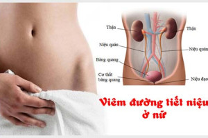 cac-trieu-chung-nhan-biet-som-tinh-trang-viem-duong-tiet-nieu-o-nu-gioi