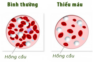 cac-trieu-chung-nhan-biet-thieu-mau-la-gi-dieu-tri-benh-thieu-mau-nhu-the-nao