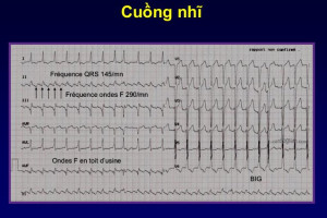 cac-yeu-to-lam-gia-tang-nguy-co-mac-benh-cuong-nhi