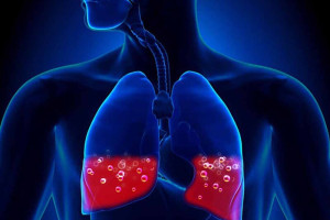 cach-dieu-tri-hieu-qua-benh-phu-phoi-cap