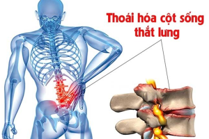 cach-dieu-tri-thoai-hoa-cot-song-that-lung-hieu-qua