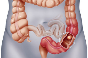 cat-polyp-dai-trang-co-dau-khong-sau-khi-cat-polyp-dai-trang-can-luu-y-dieu-gi