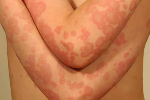 chan-doan-va-dieu-tri-hong-ban-da-dang-bang-cach-nao