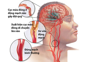 chi-phi-dat-stent-dong-mach-canh-la-bao-nhieu