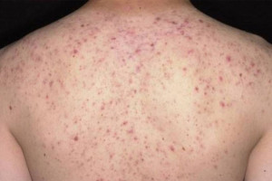 chia-se-cach-dieu-tri-viem-nang-long-don-gian-tai-nha