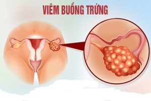 dau-hieu-nhan-benh-viem-buong-trung-va-cach-dieu-tri-benh-hieu-qua