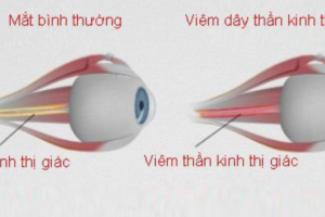 dieu-tri-phuc-hoi-benh-viem-day-than-kinh-thi-giac-nhu-the-nao