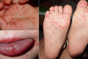 gia-tang-so-ca-mac-tay-chan-mieng-tai-dak-lak