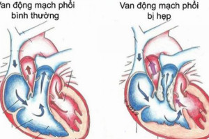 hep-van-dong-mach-phoi-la-gi-va-co-nguy-hiem-khong