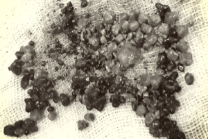 loai-bo-hon-200-vien-soi-tui-mat-cho-nu-benh-nhan