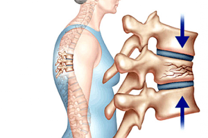 nguyen-nhan-gay-ra-xep-dot-song-la-gi-co-chua-khoi-hoan-toan-benh-duoc-khong