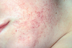 nhan-biet-benh-xuat-huyet-giam-tieu-cau-nhu-the-nao