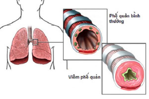 nhung-dau-hieu-nhan-biet-benh-viem-phe-quan-tre-em